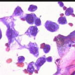 Αδενικά κύτταρα ενδοτραχήλου με ανισομεγέθεις διογκωμένους πηρήνες, επίχρισμα του 2003 